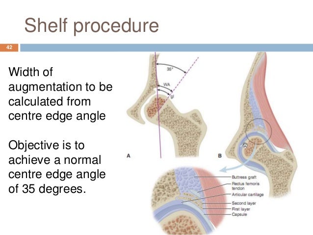 Shelf Procedure image gallery shelf osteotomy Shelf Procedure image gallery shelf osteotomy